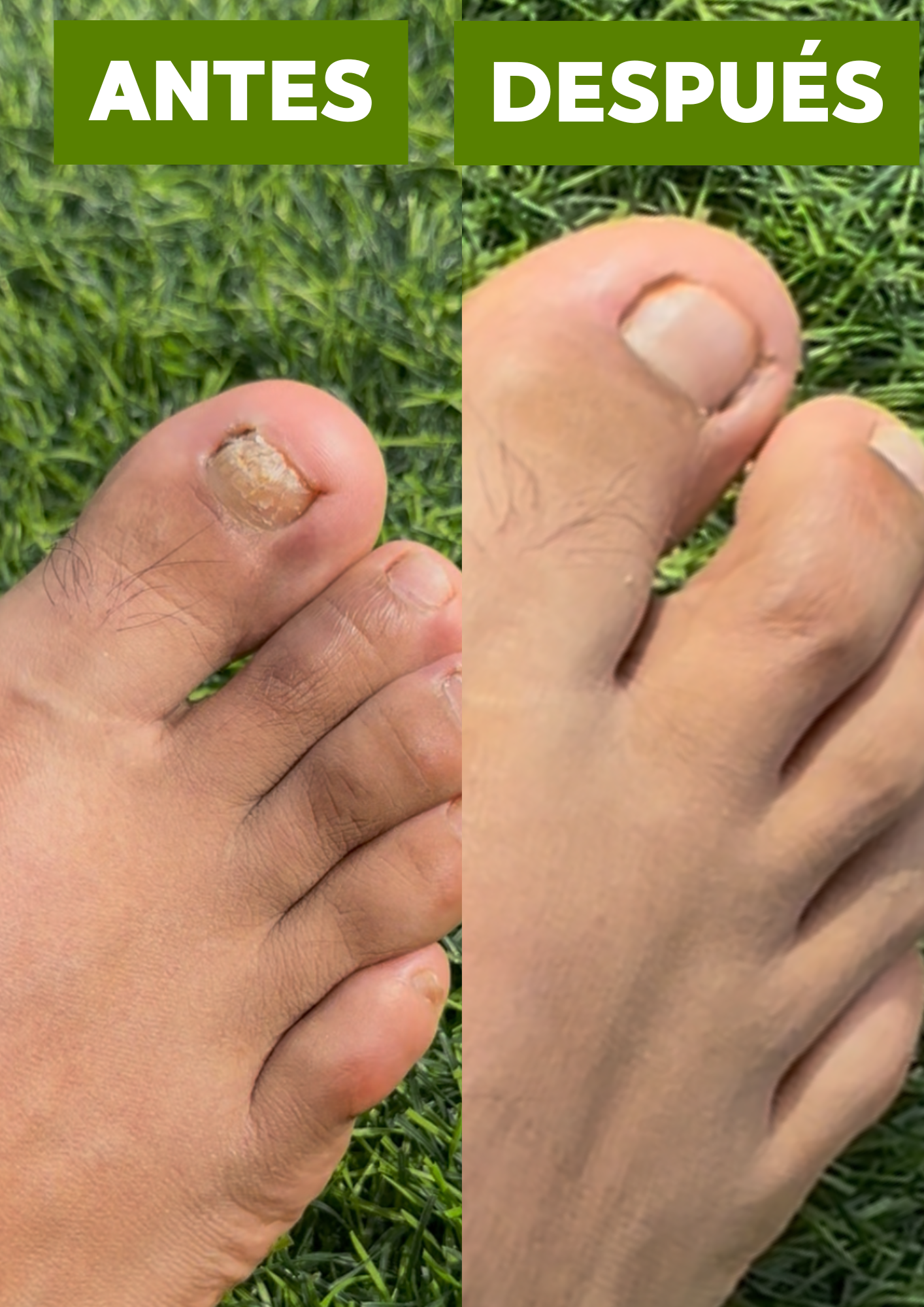 JABON ANTIMICÓTICO TERBINAFINA