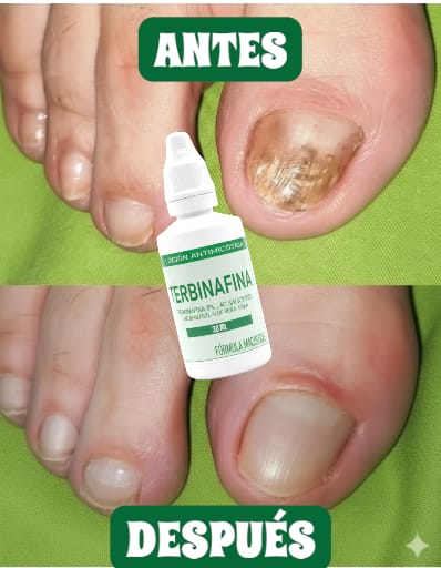 TERBINAFINA